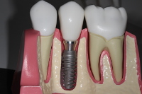 pose classique implant meaux