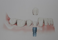 dentiste meaux remplacer dent