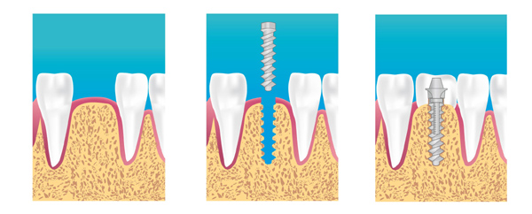 implant dentaire meaux